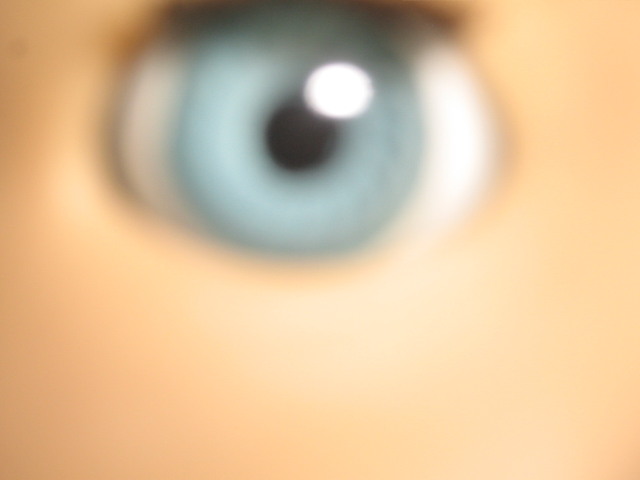 Kirsten's eye very blurry